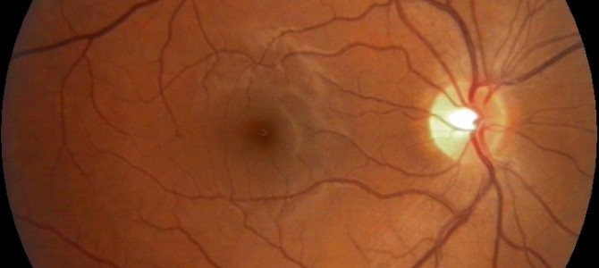 Avenç important en els transplantaments de cèl·lules mare pel tractament de la DMAE
